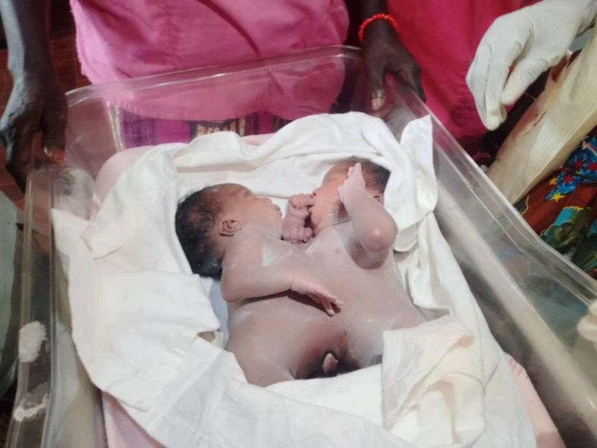 Kwilu : Les bébés siamois nés à Misay transférés à la Clinique Ngaliema (Kinshasa)